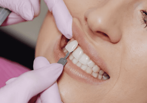 Whitening Toothpastes: Are They Worth the Price? A Comparison to Professional Teeth Whitening in Amsterdam"